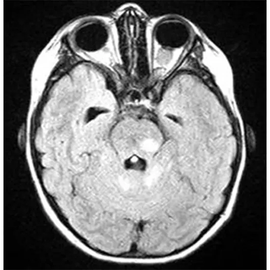 optic nerve glioma